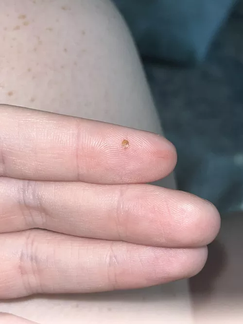 popped this from the back of my calf. i’ve never had a blackhead like this there before