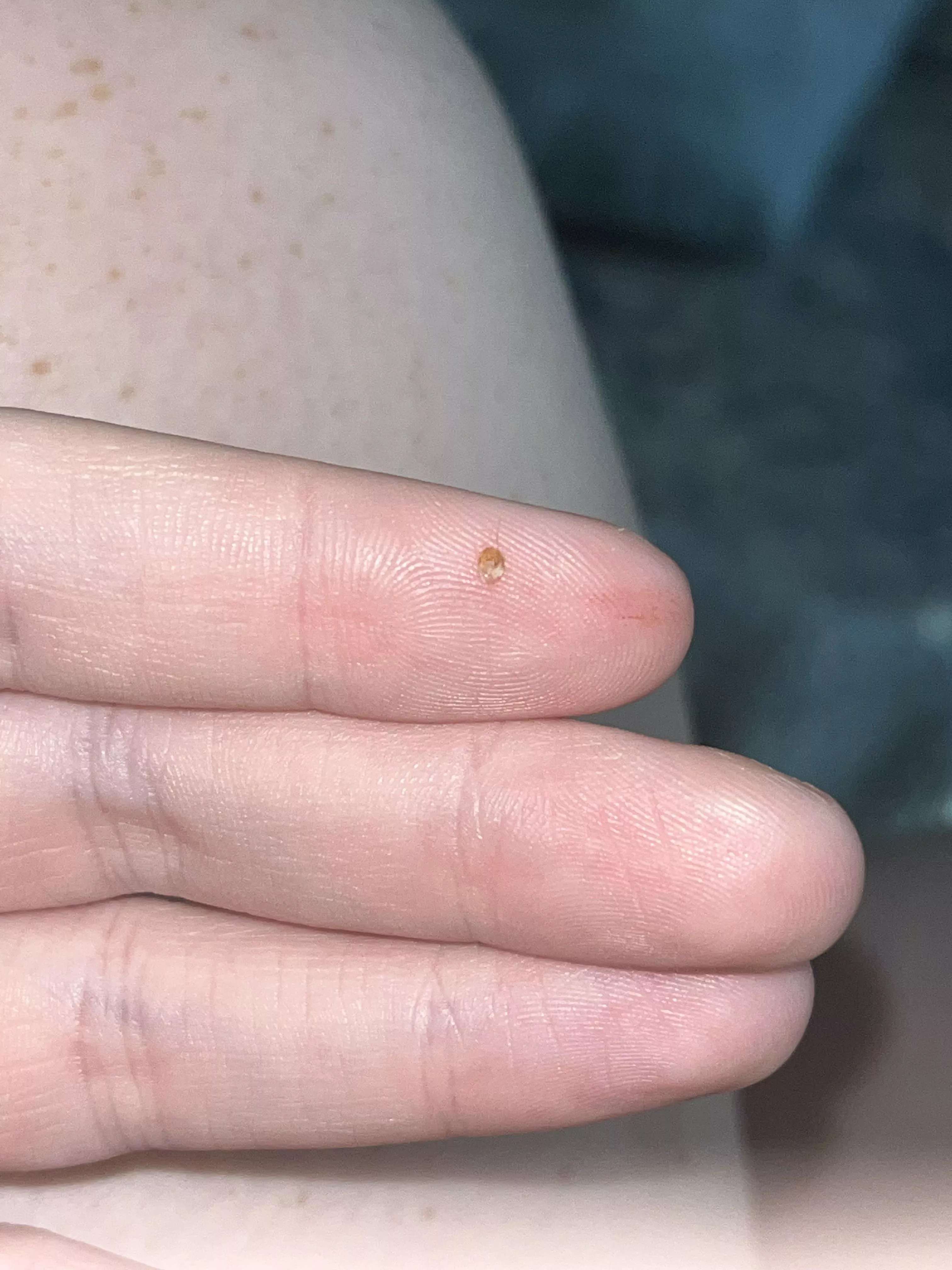 popped this from the back of my calf. i’ve never had a blackhead like this there before