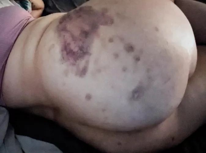 Another butt bruise for the collection 😄