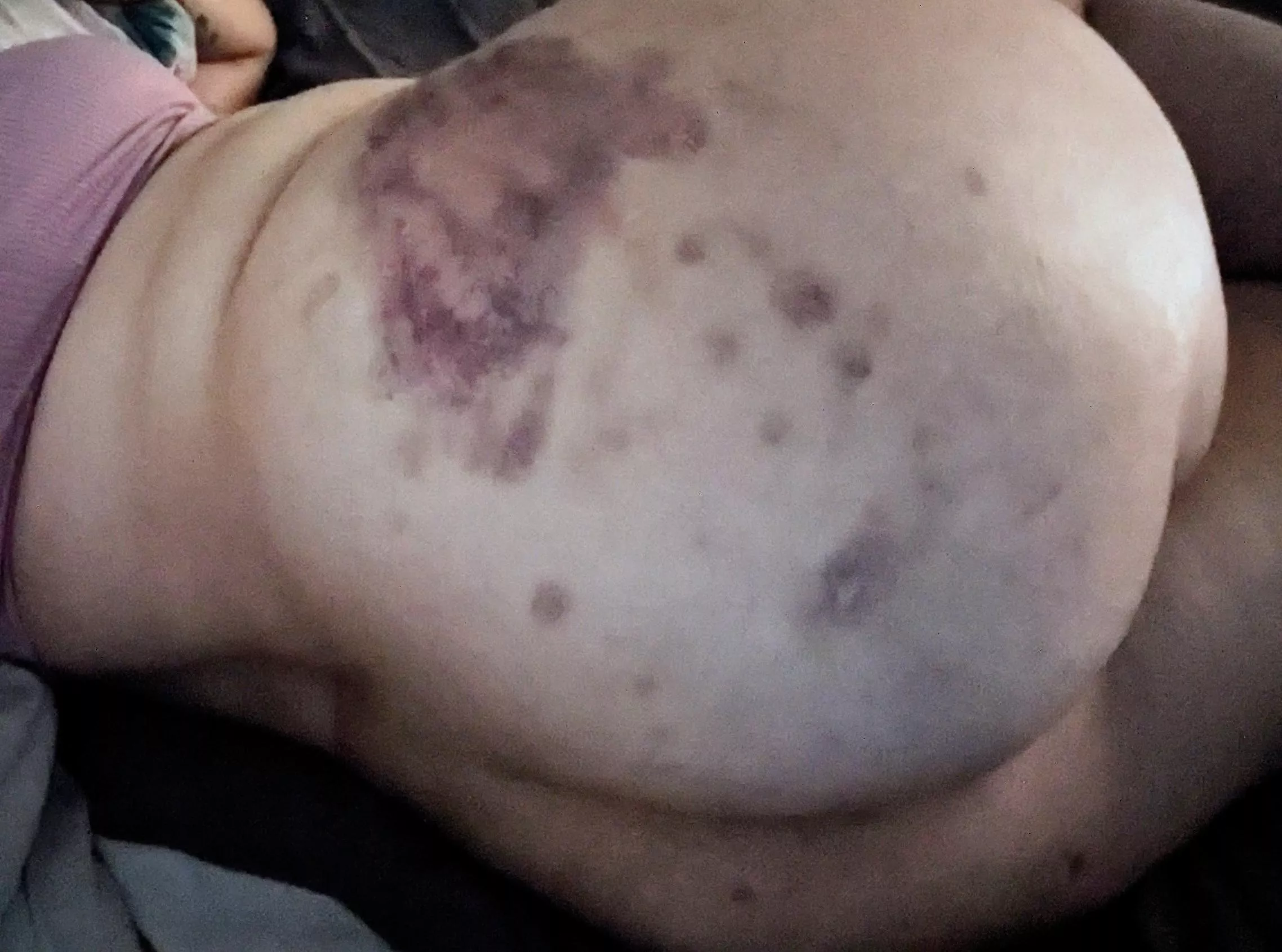 Another butt bruise for the collection 😄