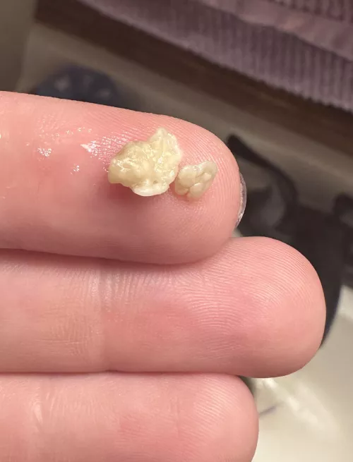 Extreme tonsil pain no longer once these popped out