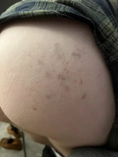 Paddling bruises - they last for days 🤤