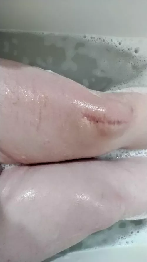 Trans thighs save lives