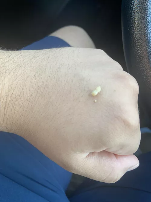 Absolute unit that came out of my tonsils.