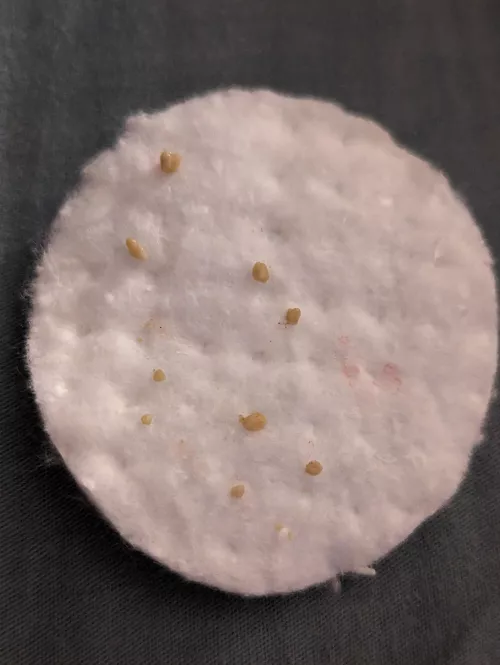 Left tonsil haul for the day.