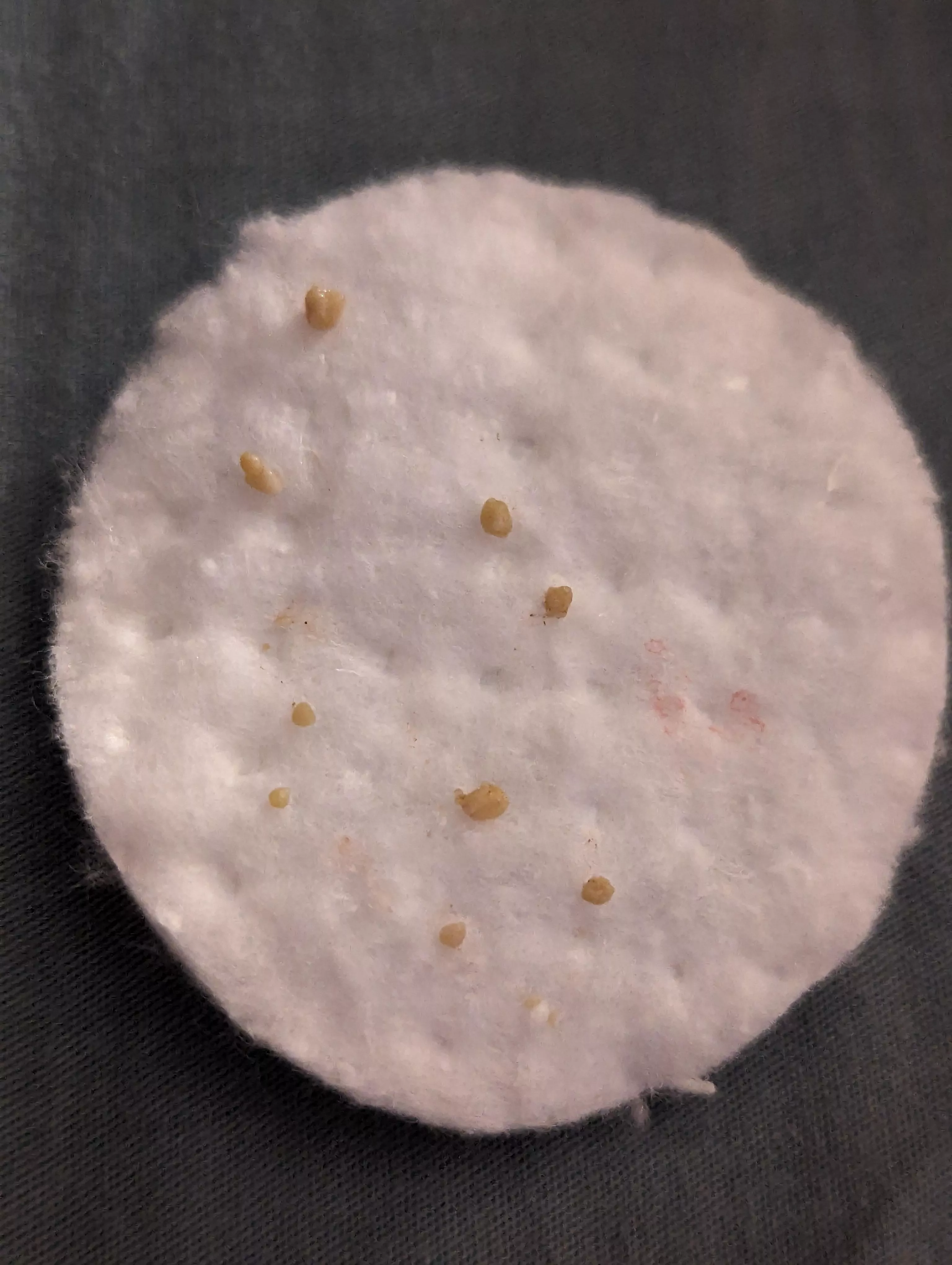 Left tonsil haul for the day.