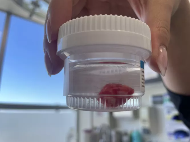 Pilar Cyst Removed on my scalp