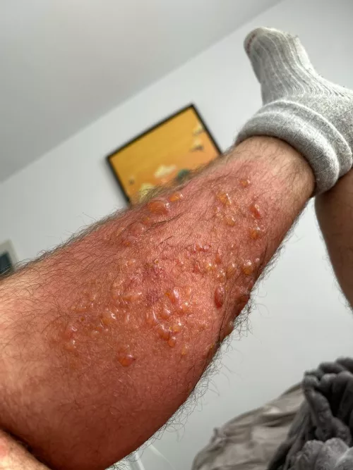 Sick and tired of poison ivy