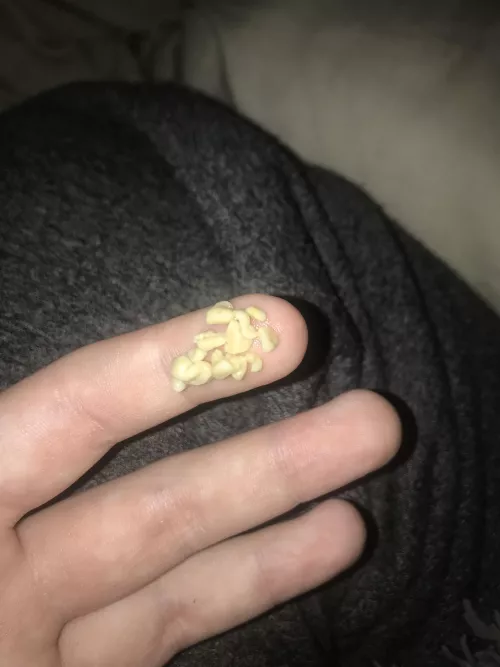 my absolute hoard of tonsil stones