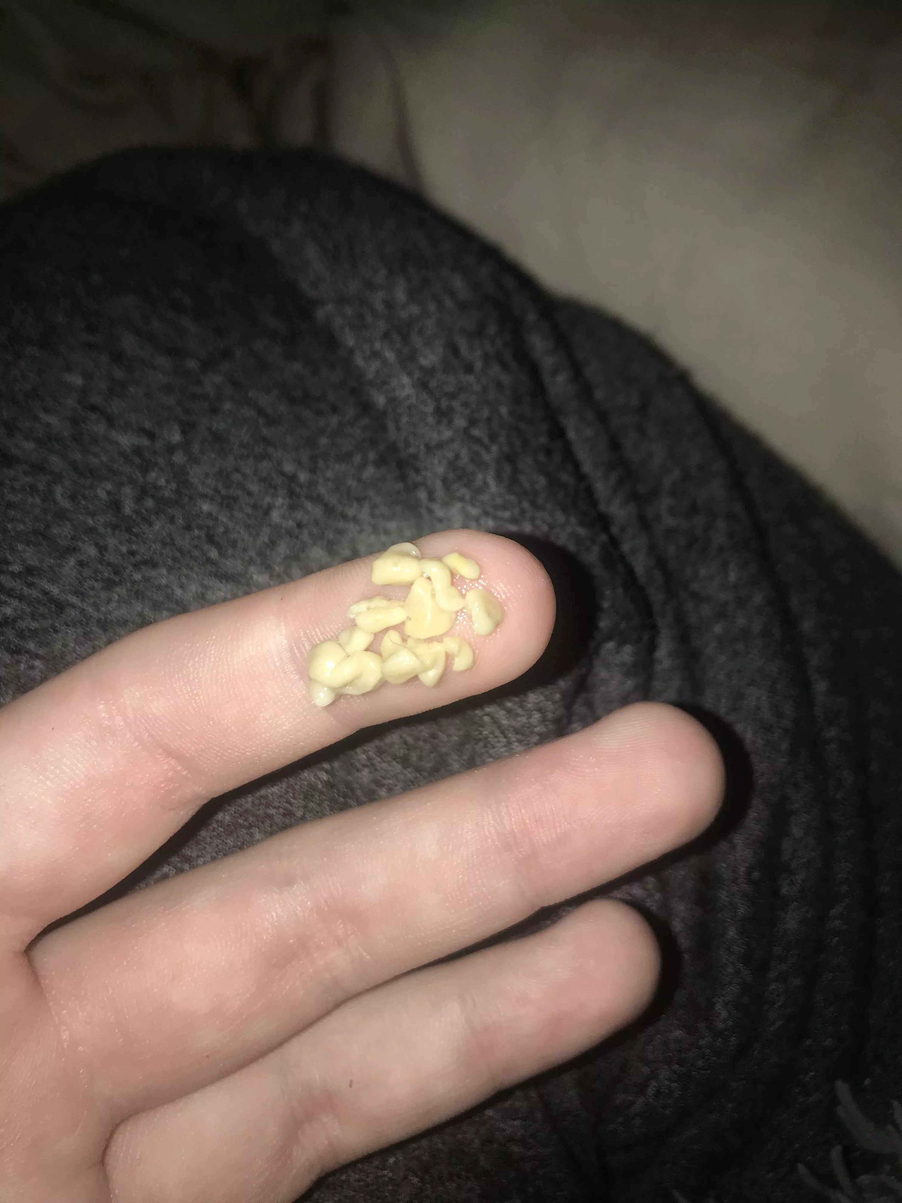 my absolute hoard of tonsil stones