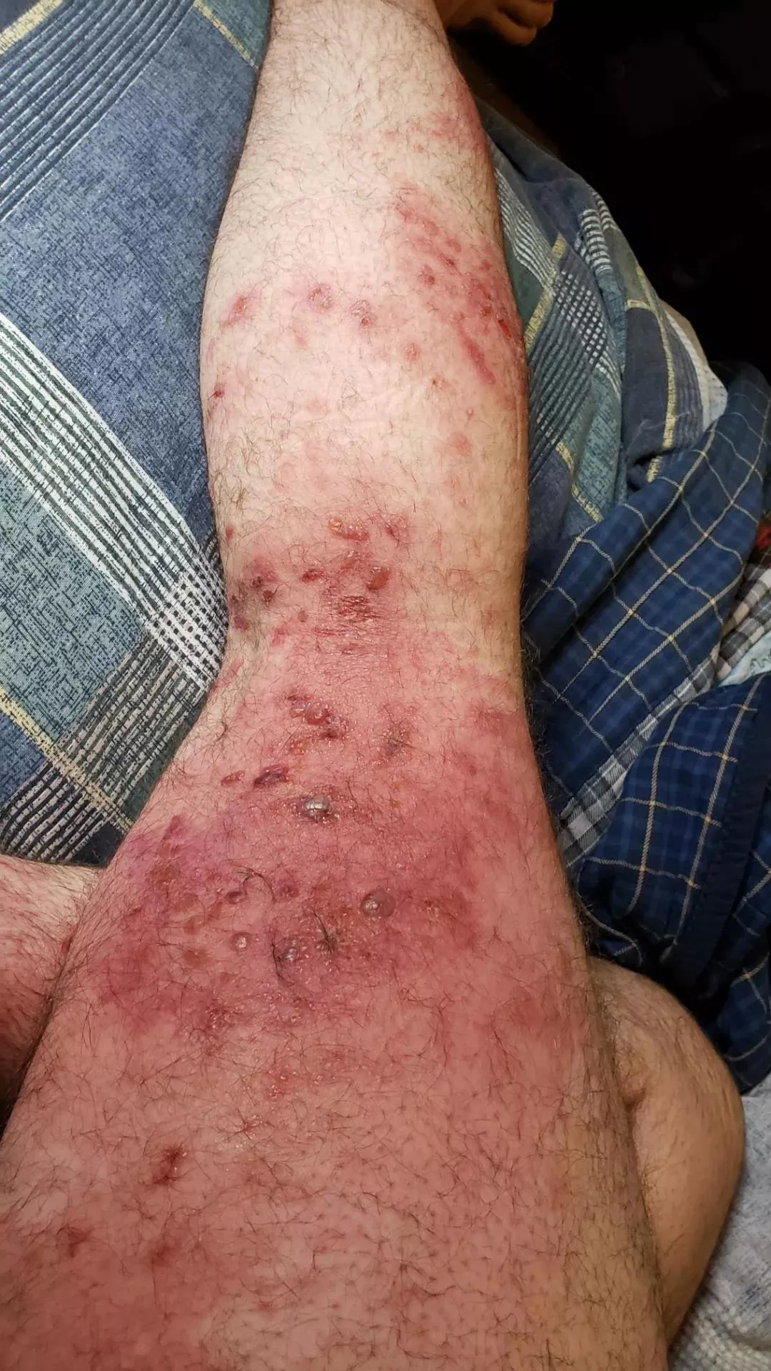 My leg looks like bubble wrap