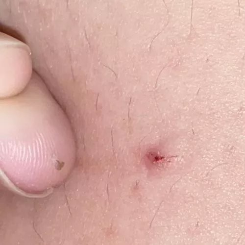 This ingrown hair I popped out of my thigh