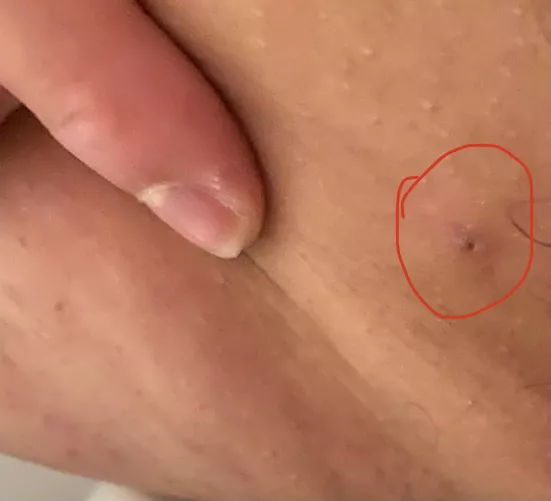 Fellas I found what I think is a giant pimple (it feels bigger than it looks) on my inner thigh. Problem is; how tf do I film it?