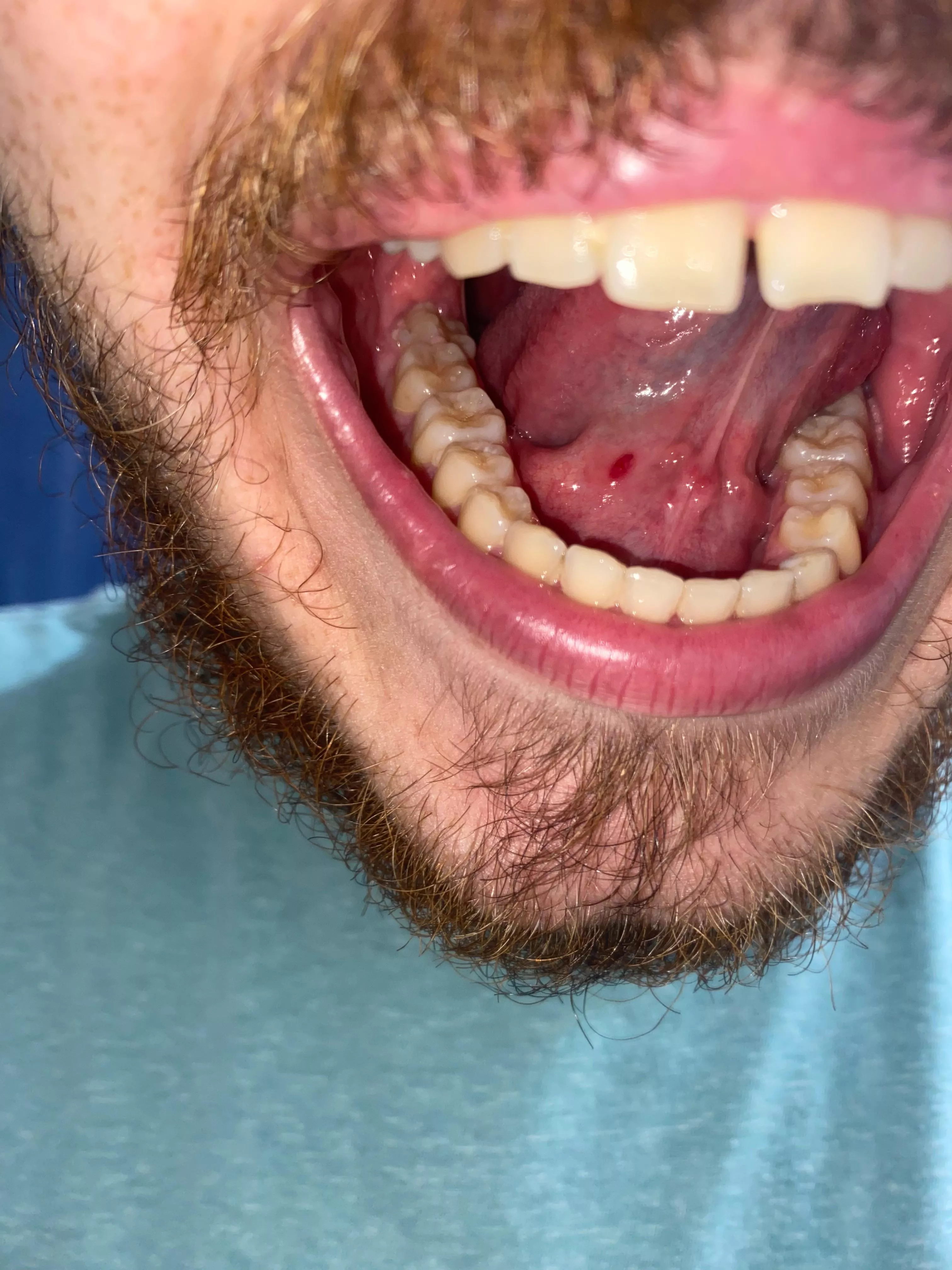 Help! I felt a really round lump under my tongue, I barely touched it and it popped. Wtf is this?