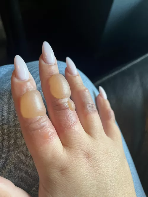 I know I can’t pop these but oh man…