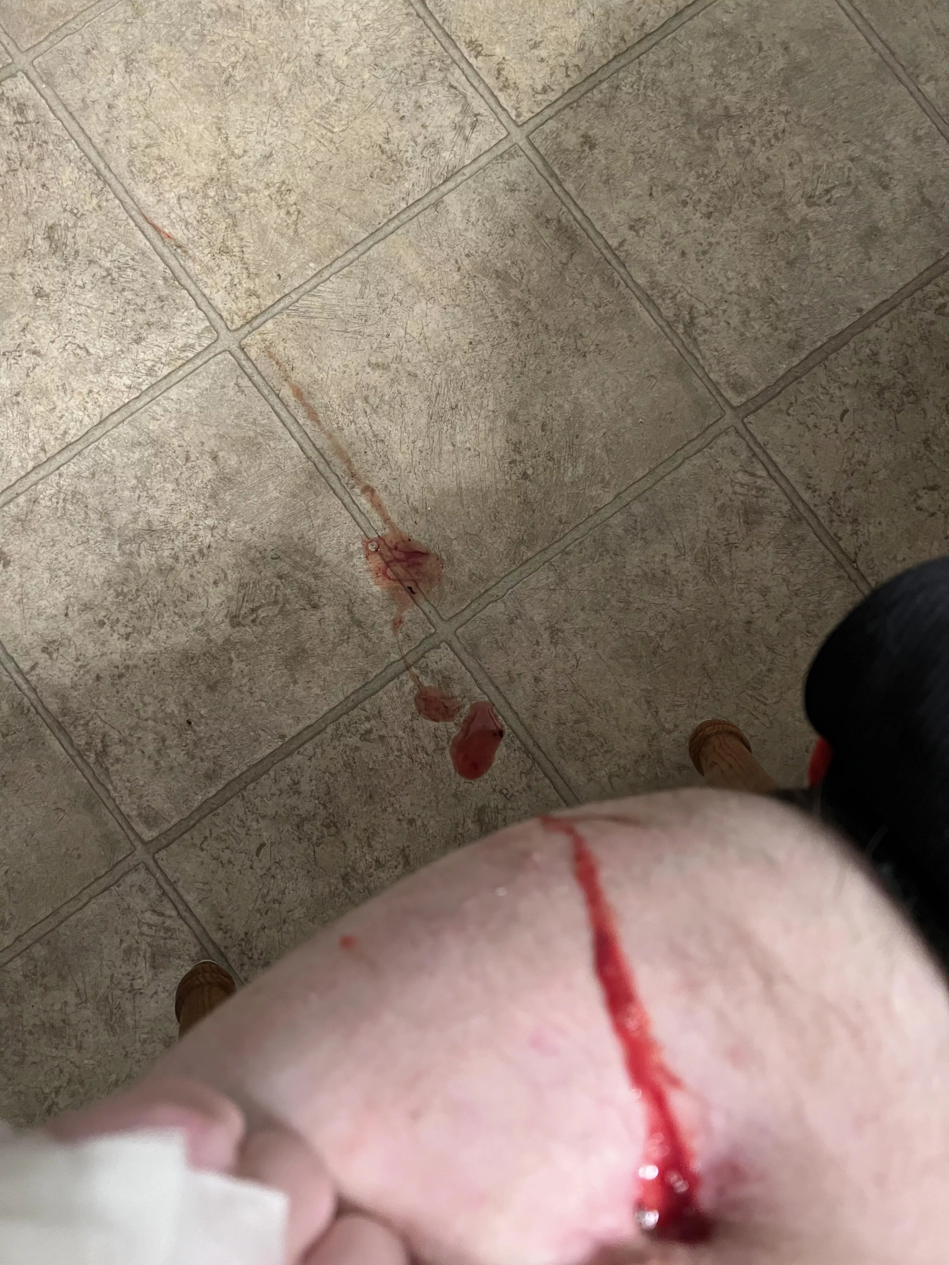 Osteomyelitis surprise explosion on my hip which flew a few feet. Photo only since I wasn’t expecting it lol. NSFW just because of upper thigh, no nudity.