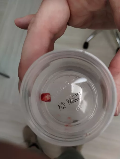 This cyst was removed from my back today