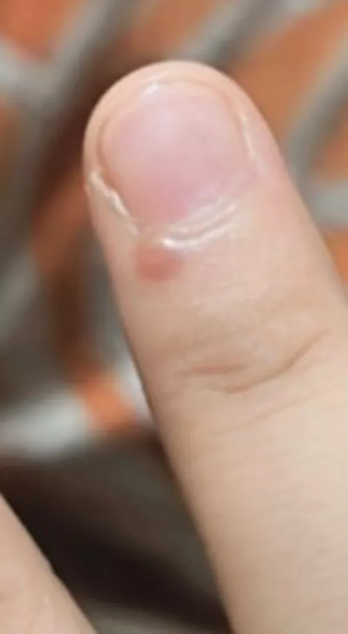 what's this small bump? it aches