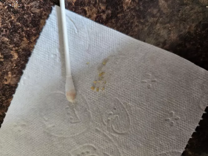 Tonsil stone haul after only 1 day