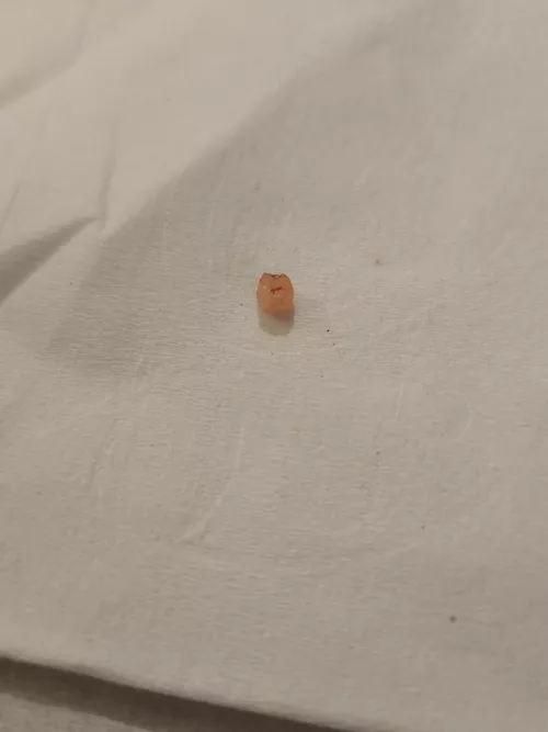 Farewell to one of the tiny cysts on my head