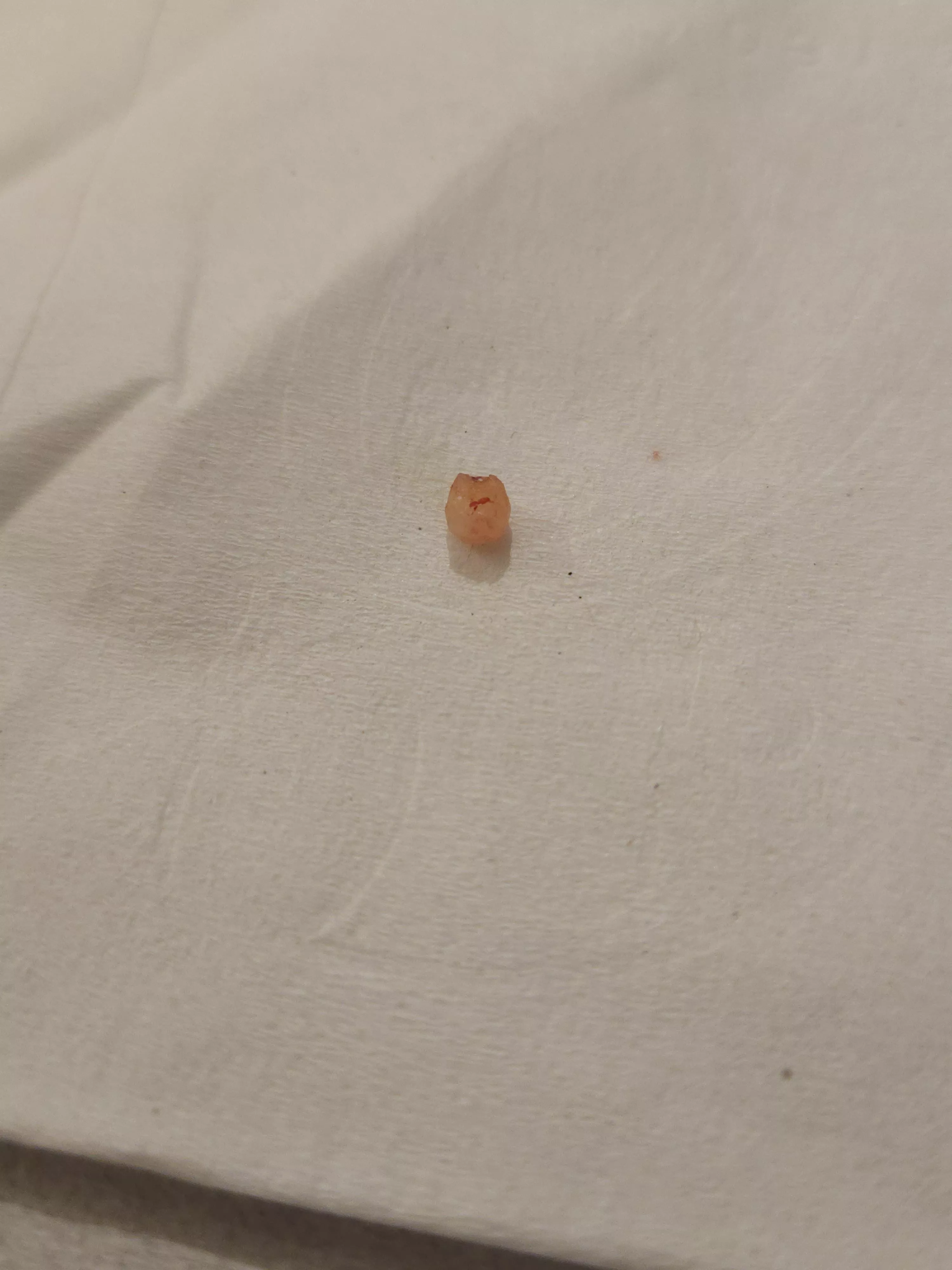 Farewell to one of the tiny cysts on my head