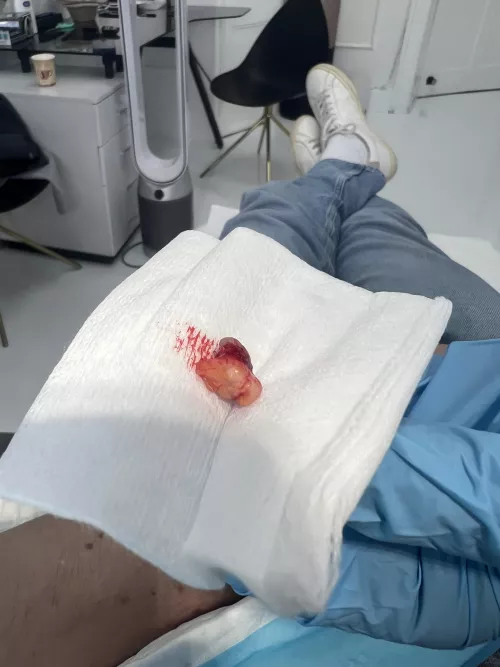 Cyst removed from my arm