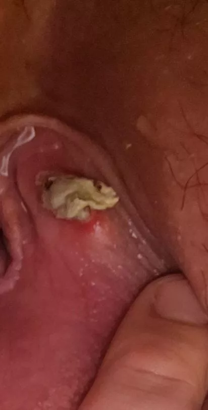 Bartholin's Cyst Wall Coming Out