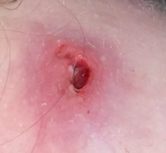 Hole from a sebaceous cyst I’ve been battling with for 2 weeks