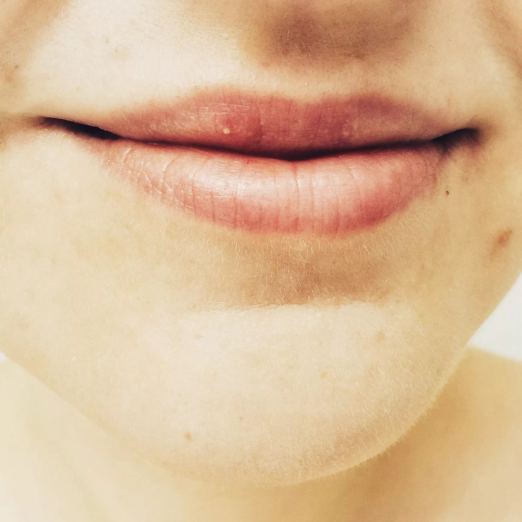 A whitehead in the middle of my upper lip - first time I've had one of these