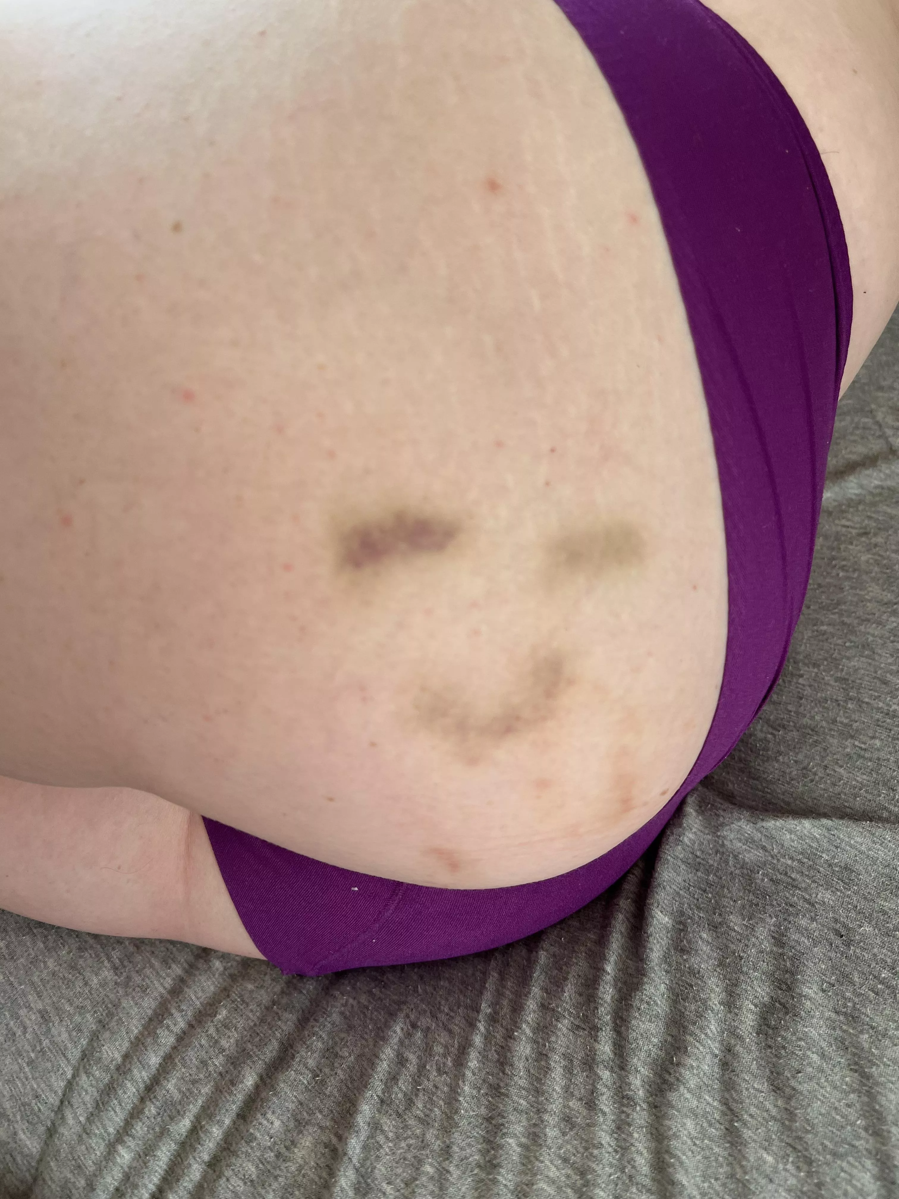 My bruises are happy to be here ☺️