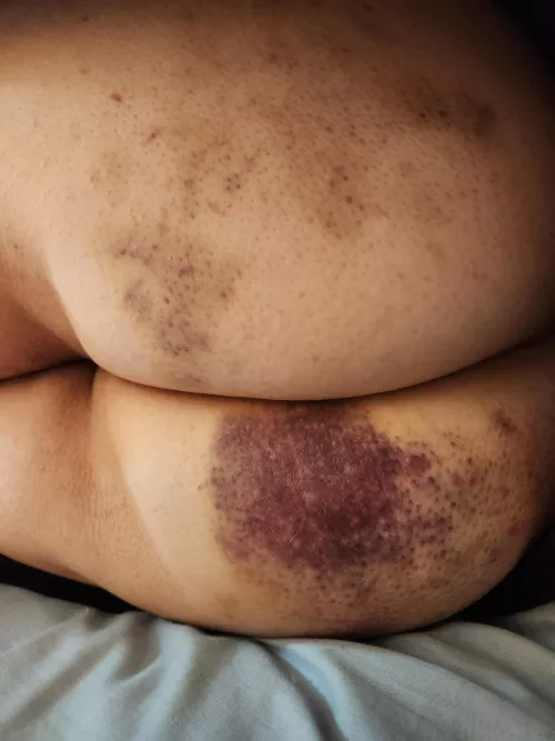 Flogged hard in front of everyone at the club this past weekend! 🥰