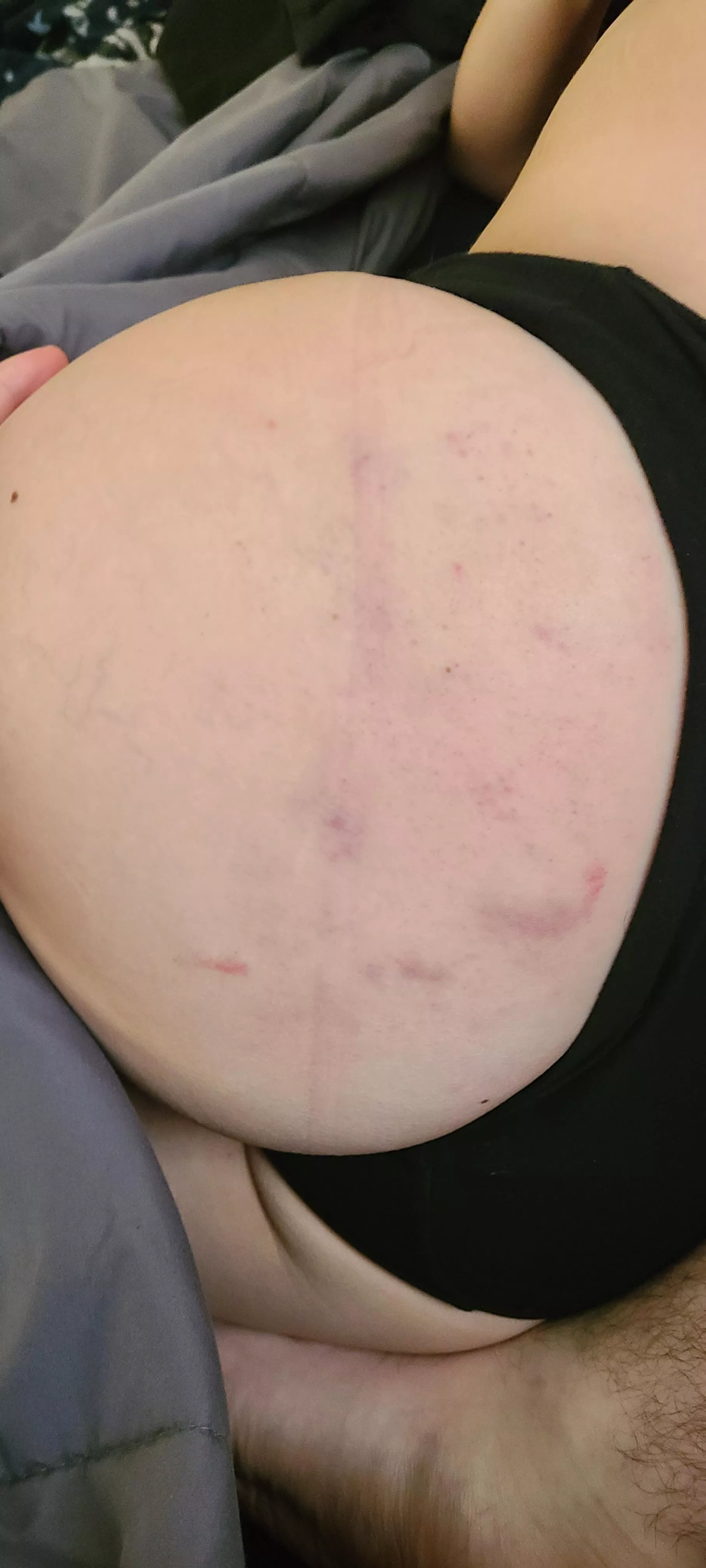 Aftermath of yesterday's booty slaps