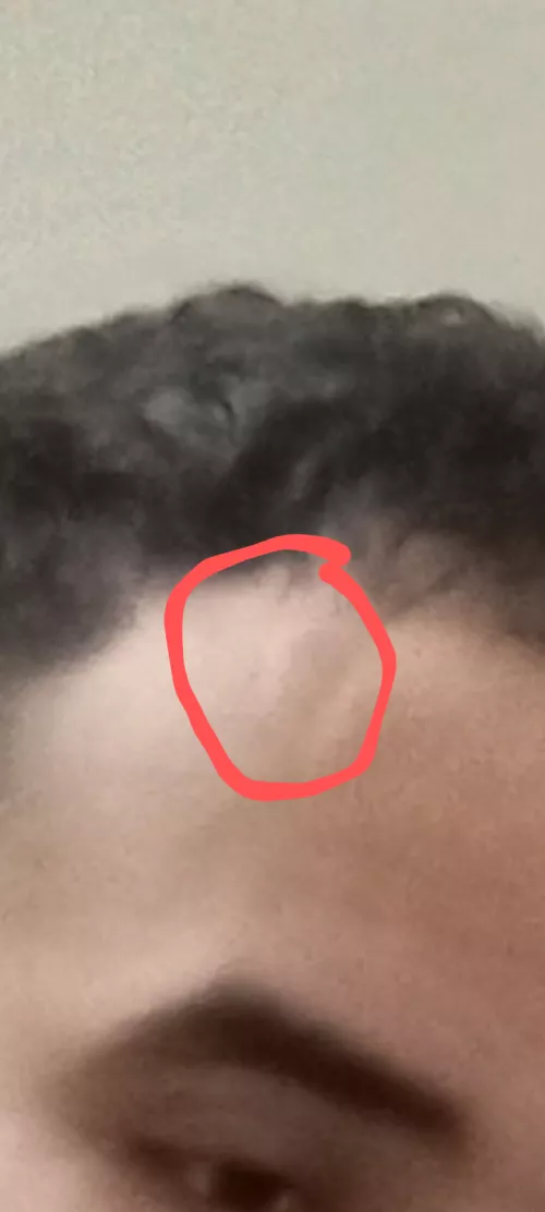 Bump on forehead for years not sure what it is