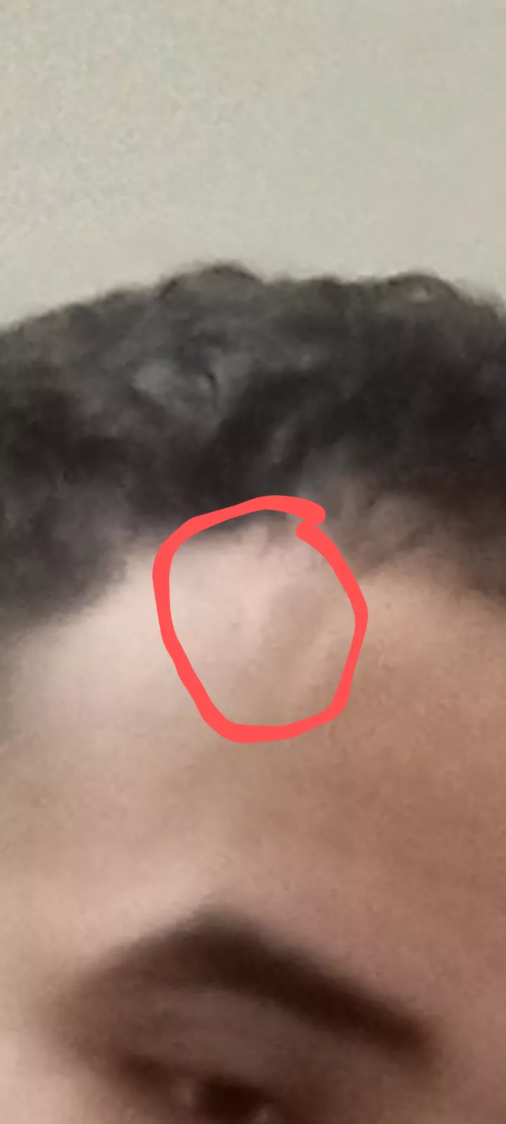 Bump on forehead for years not sure what it is