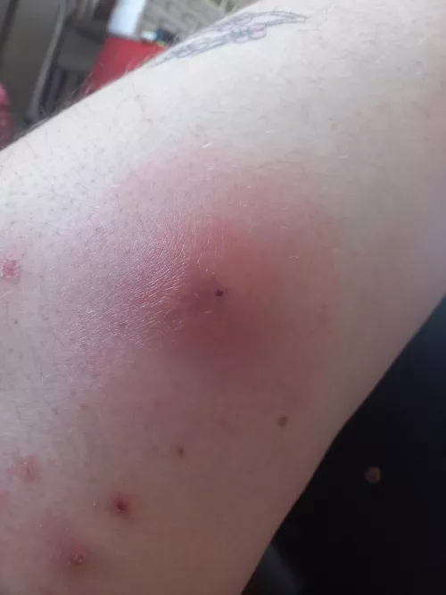 Update on massive cyst boil thing