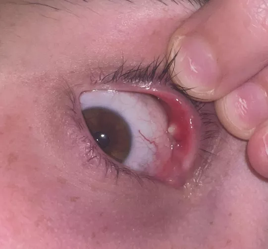 Largest Internal Stye I’ve Ever Had