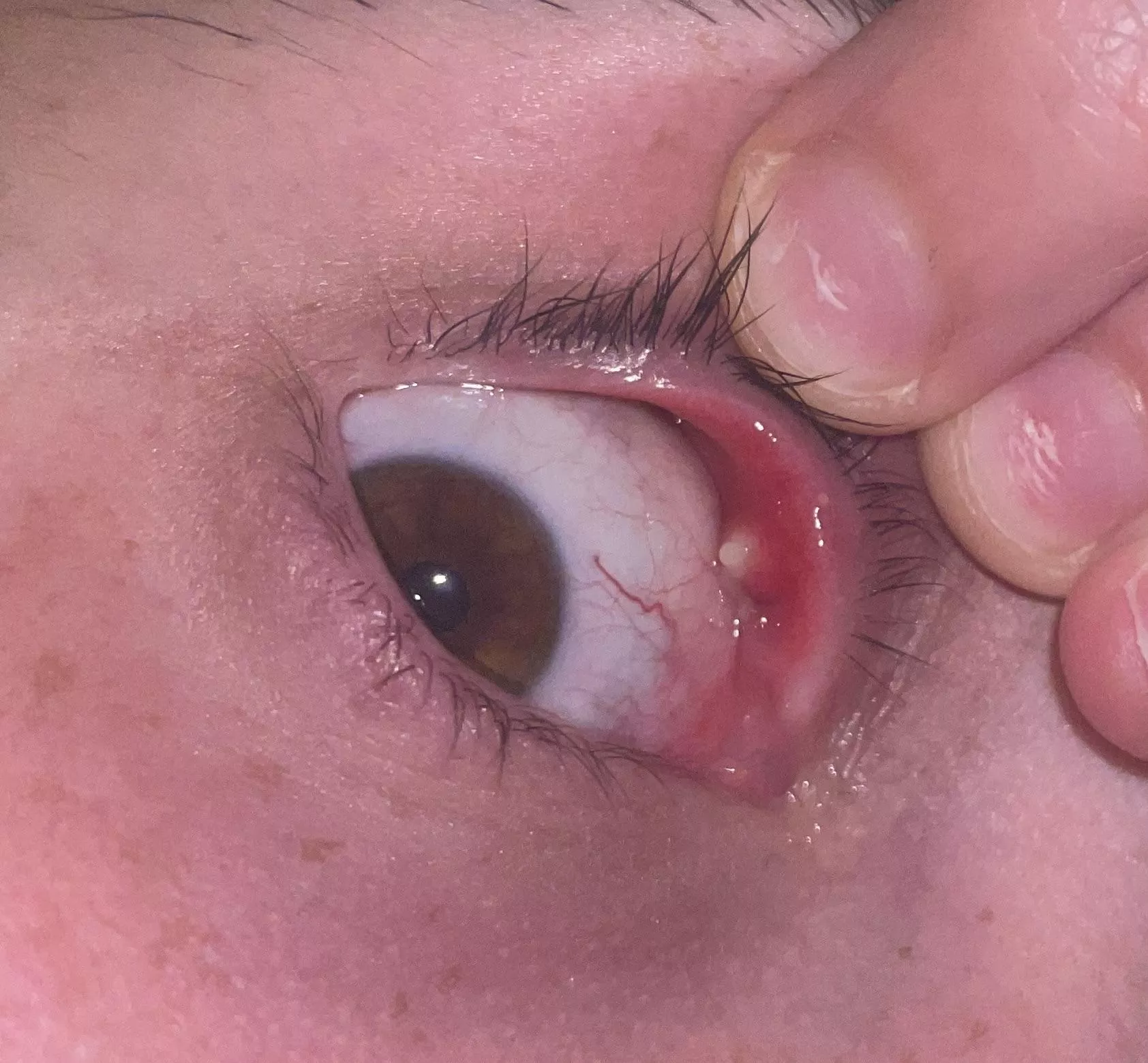 Largest Internal Stye I’ve Ever Had