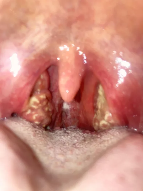 Absolutely gnarly strep throat. Never had it before and hurt so bad I had to go to the emergency room and get Percocet. I’m barely able to swallow and foods or liquids. It’s a 10/10 pain when I have to swallow. Currently spitting in a bottle.