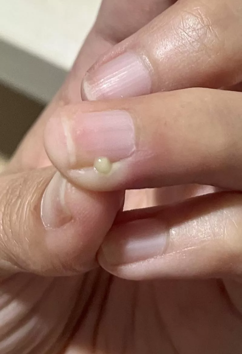 Used a (sterilised) needle to pop and it felt nice