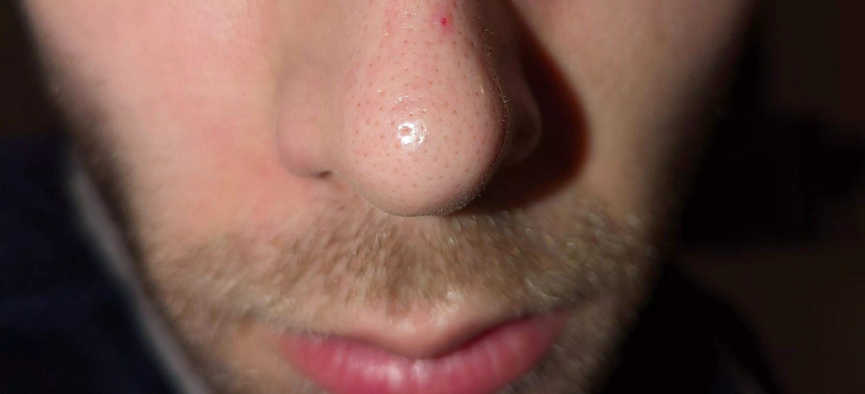 I've had this red dot on my nose for a year after having a pimple there. What is it?