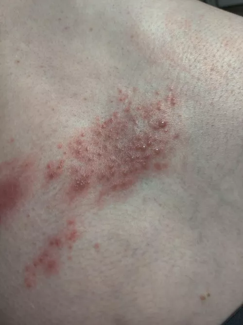 Forbidden pops - hubs got shingles