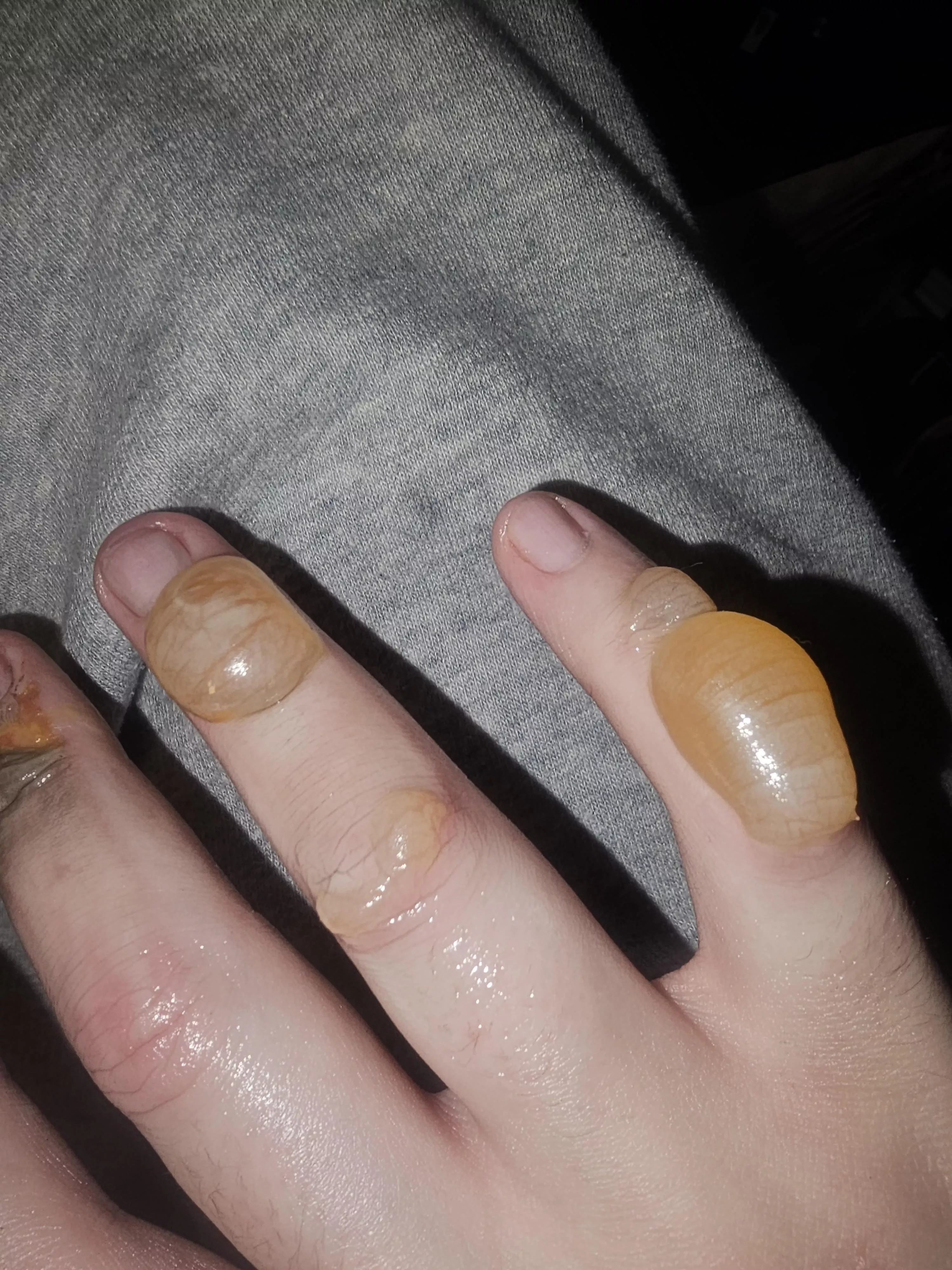 Have been told to avoid popping these, my urges have never been greater though 😭