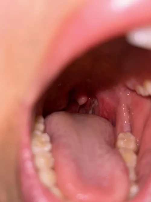 Is it tonsillitis or an abscess?