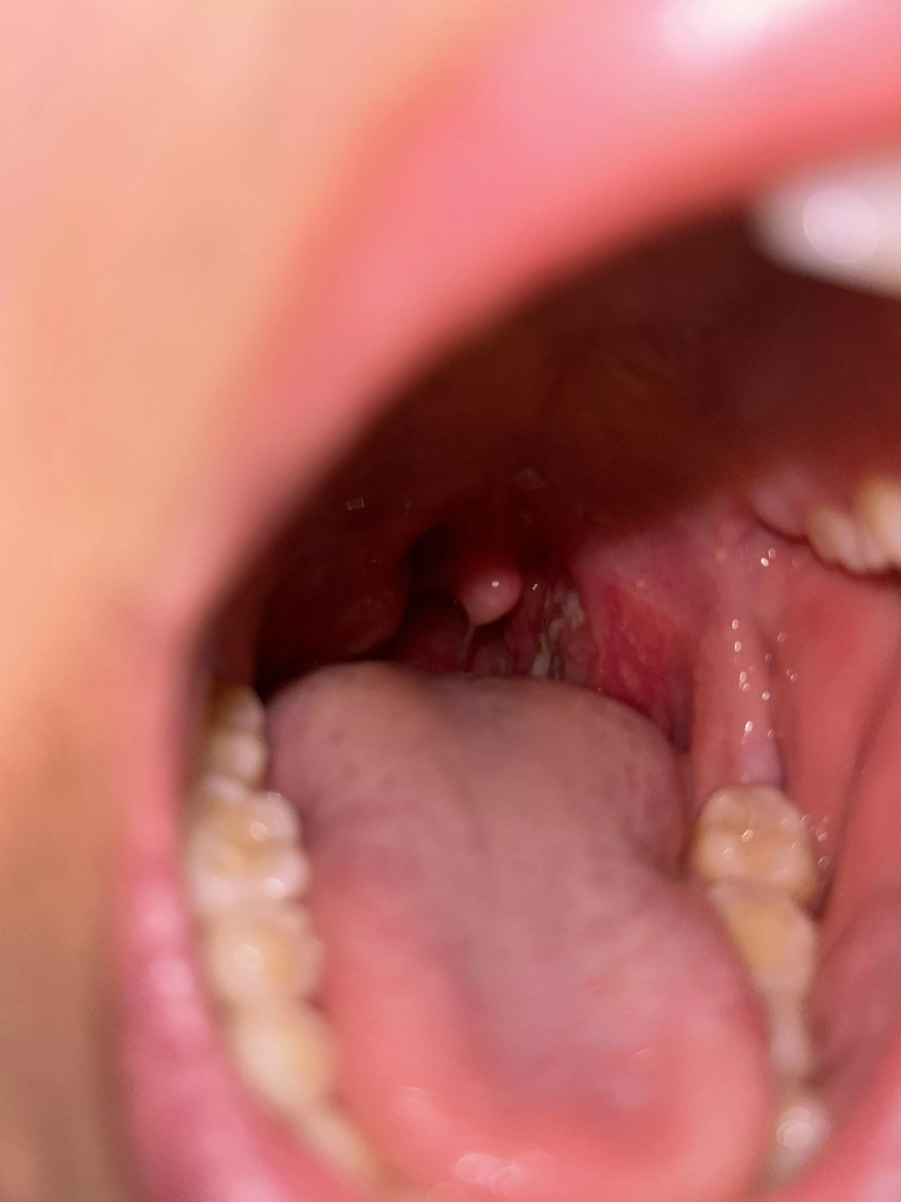 Is it tonsillitis or an abscess?