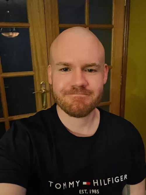 Embraced my baldness and feeling better than I anticipated