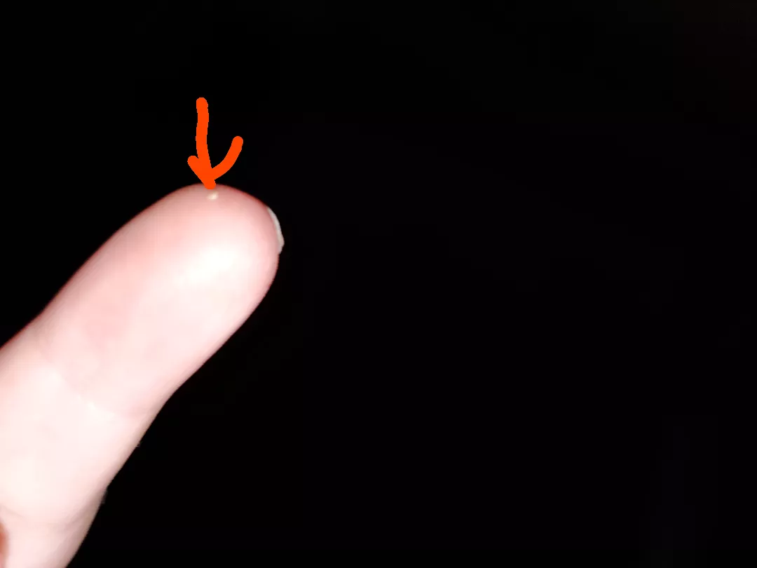 Really gross keratin plug I popped out of my forehead