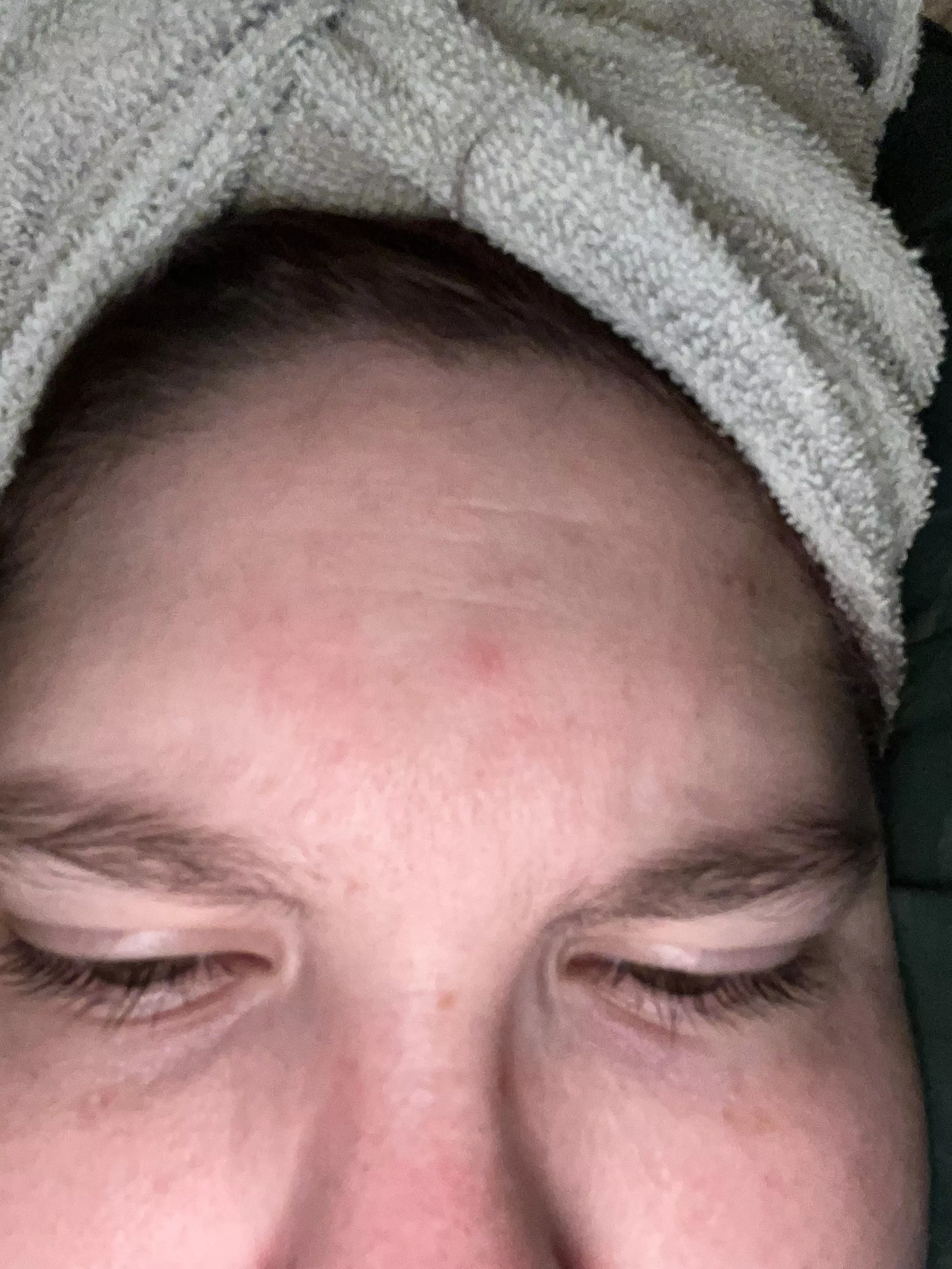 I’m getting married Sunday so of course I develop a pimple right in the middle of my forehead and of course I scratch it in my sleep and make it even more irritated🙃