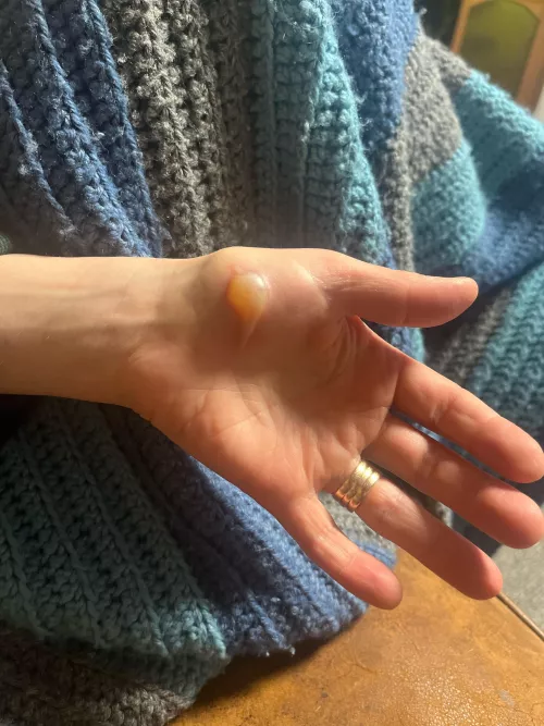 Forbidden pop from a burn.