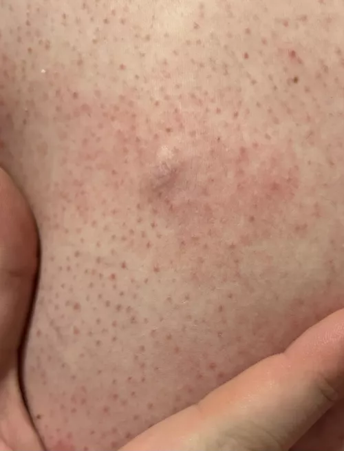 Just rolled over in bed and this little guy I’ve had for years just popped on his own. Popped under the skin though, not used to that one