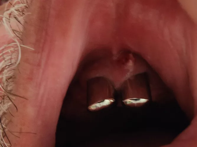 My father's last two upper teeth. He felt a sudden sharp pain under his prosthetic, and that's what we found underneath.